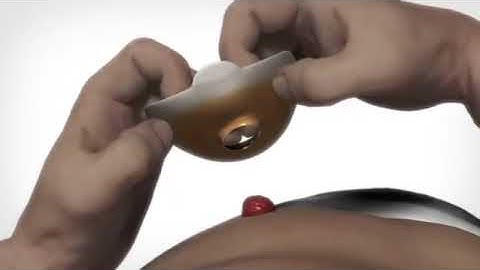 Applying a 2-piece SenSura Click closed ostomy pouch