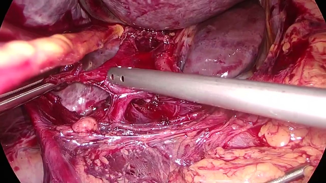 Laparoscopic total gastrectomy D2 dissection
