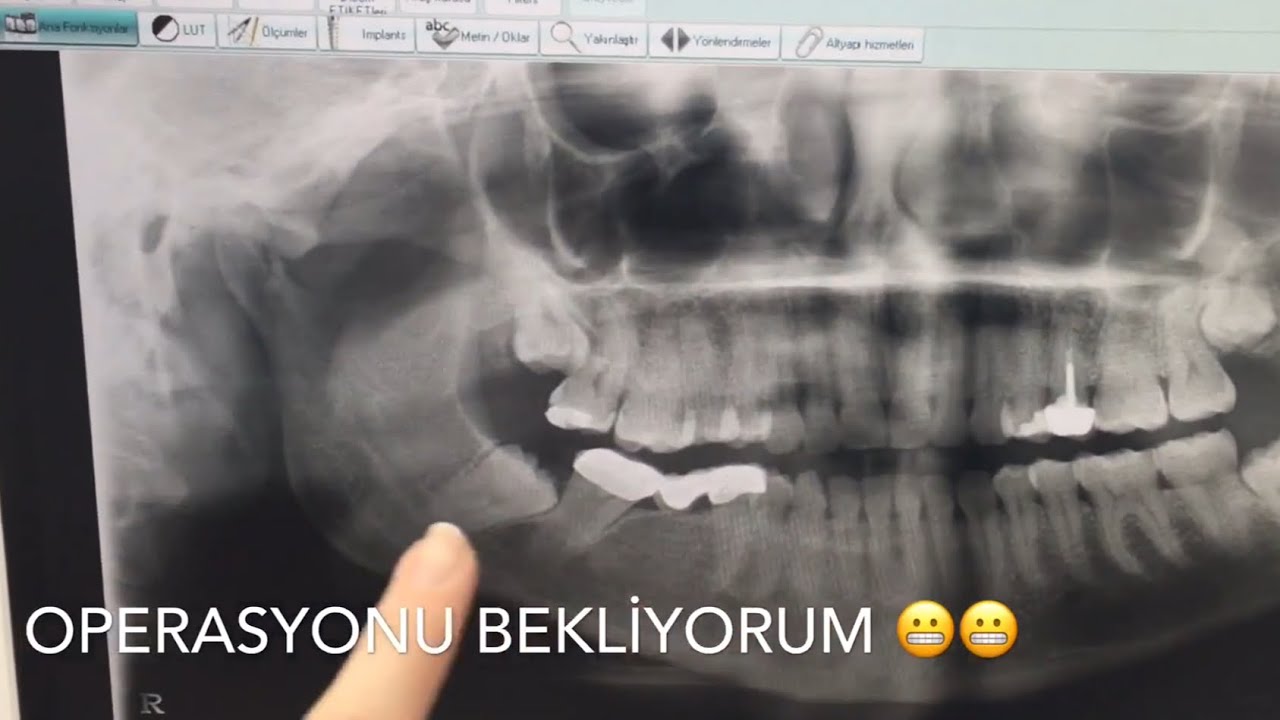 20 Lik Dis Cekimi Ve Fiyati Aliadent