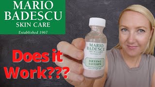 Mario Badescu Drying Lotion REVIEW II Does it Actually WORK?