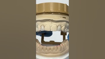 Beautiful anterior esthetics made using Chairside Shade Guide 8.0