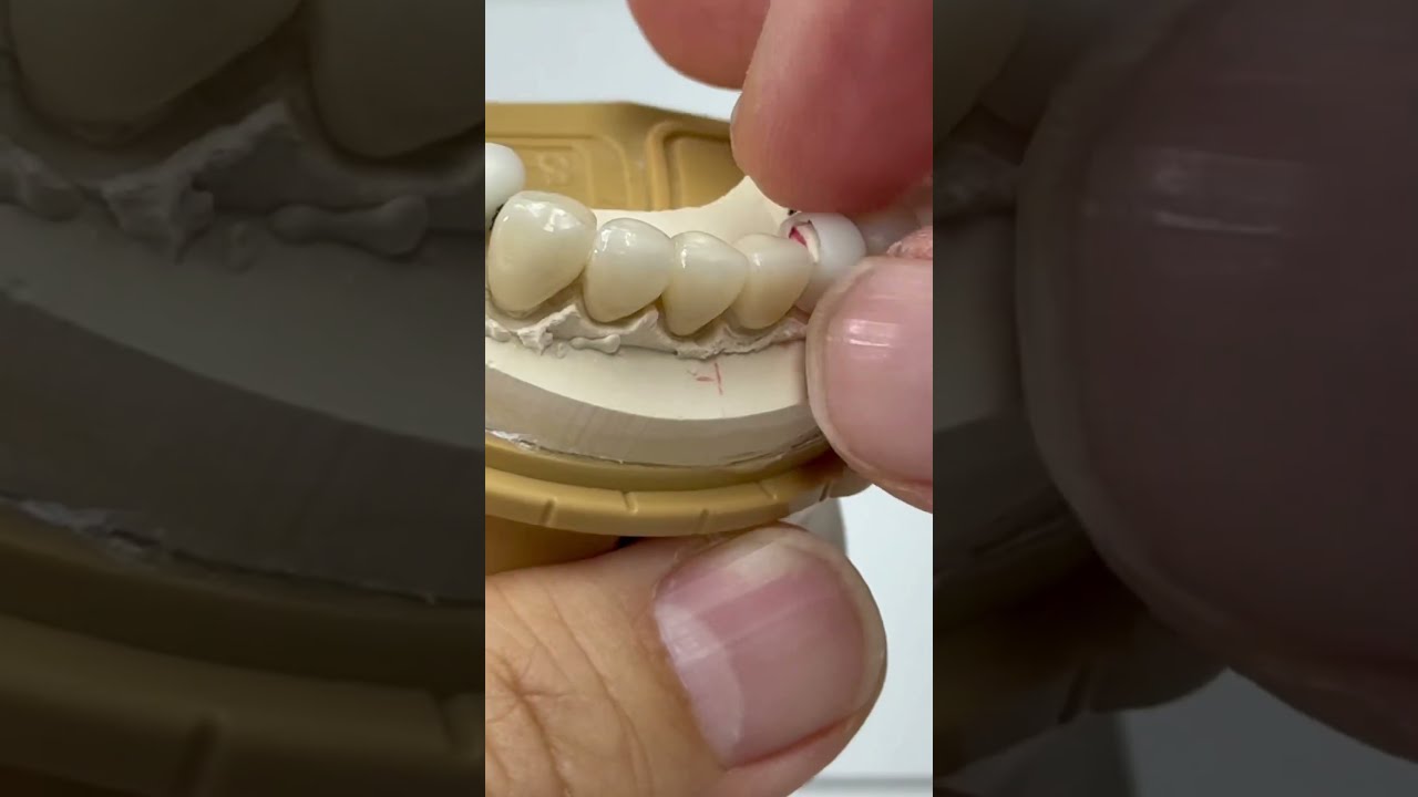 8 Unit From Two Reduction Copings 
