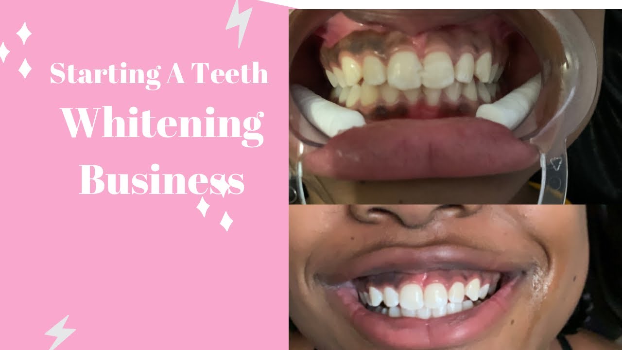 How To Start A Teeth Whitening Business!! #Startingteethwhiteningbusiness