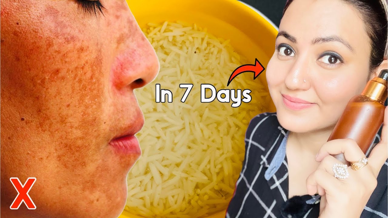 Rice Water Challenge : Lighten Your Scars, Dark Spots, Discoloration & Get Glowing Spotless Skin💕
