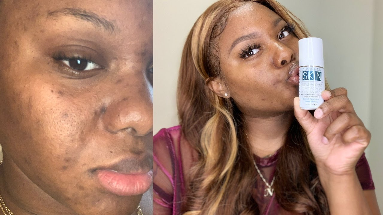 HOW TO GET RID OF ACNE SCARS AND HYPERPIGMENTATION / ADMIRE MY SKIN