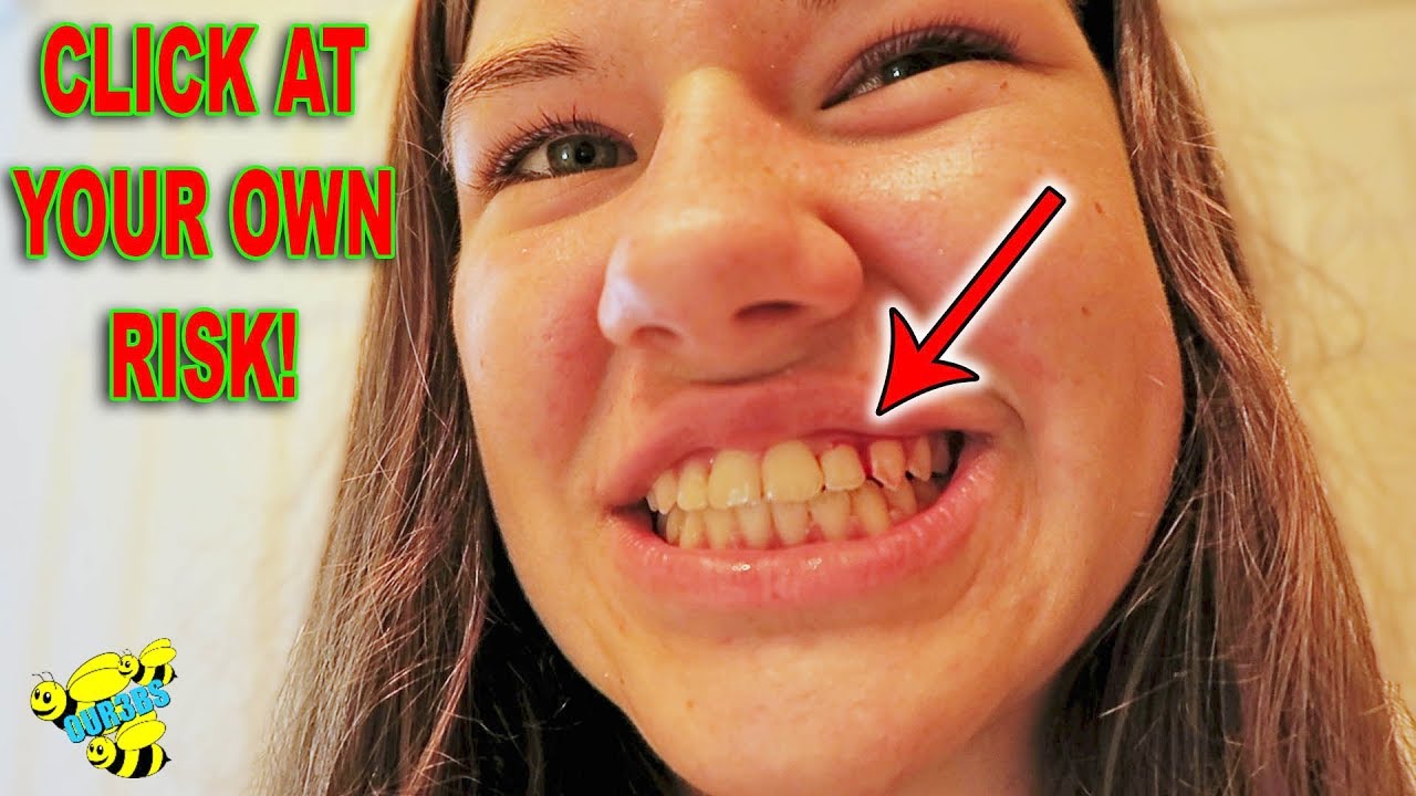 First time braces
