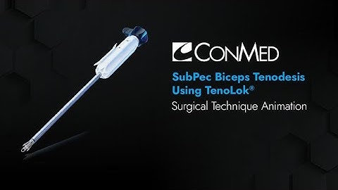 SubPec Biceps Tenodesis Using TenoLok® - CONMED Animation