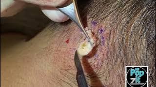 Firmly packed neck cyst. Big squeeze and pop. Full cyst excision and closure. MrPopZit.
