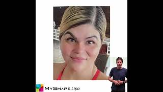 Top 5 Procedures At Myshape Lipo