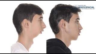 Cirugía Ortognática Bimaxilar. Mentoplastia. Caso Xavi - Clase 2, Hipoplasia Mandibular