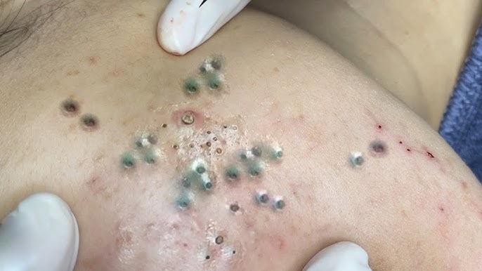 Blackheads & Acne Treatment 25.05.2024 (Part 4) #blackhead #whitehead #acne #blackheadremoval - YouTube