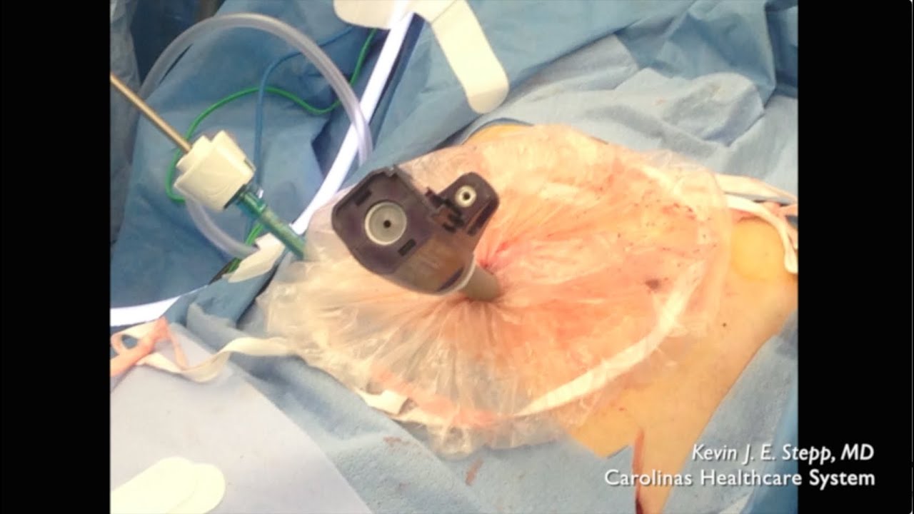 Laparoscopic Morcellation in a Bag YouTube