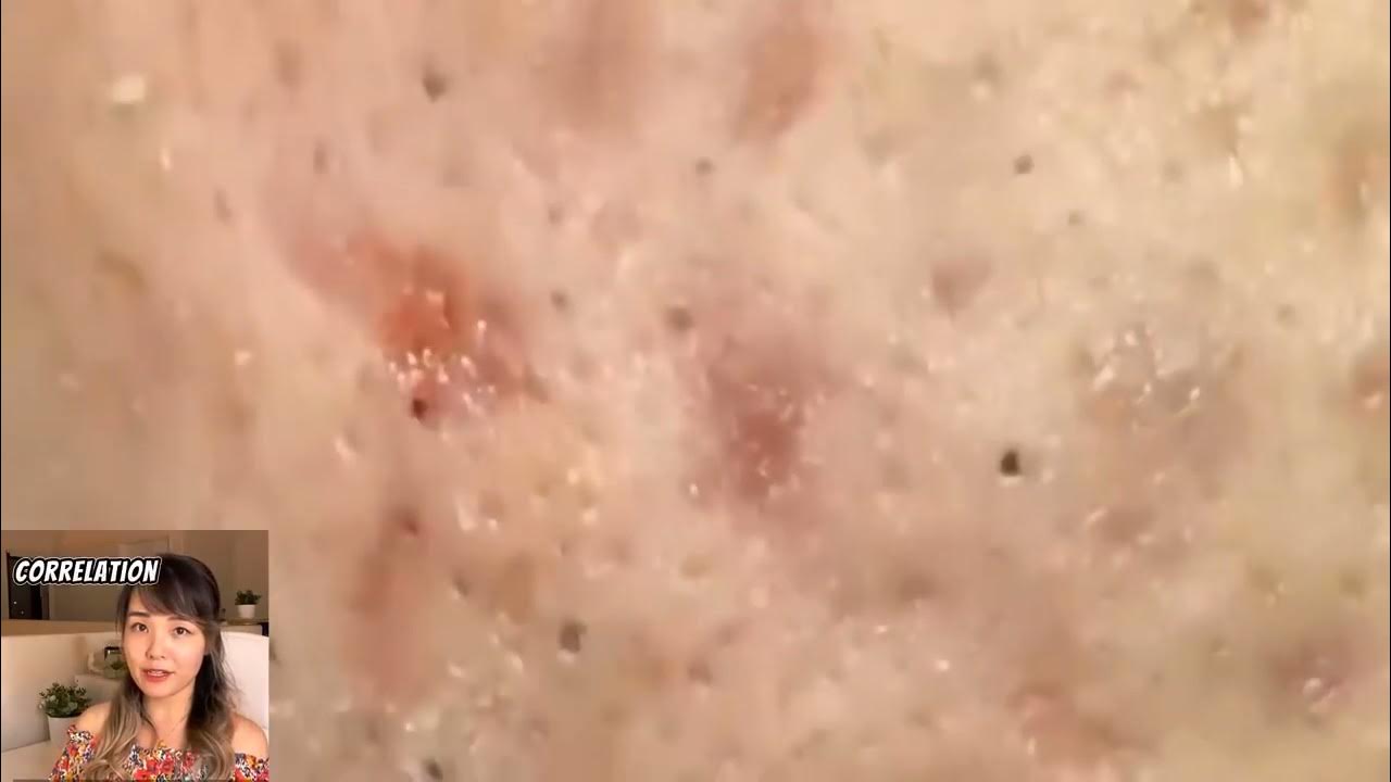 BEST BLACKHEAD & CYST POPPING 2024 YouTube