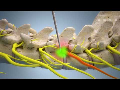 Video: Osteokondros Av 2: A Graden: Cervikal, Bröstkorg, Ländrygg
