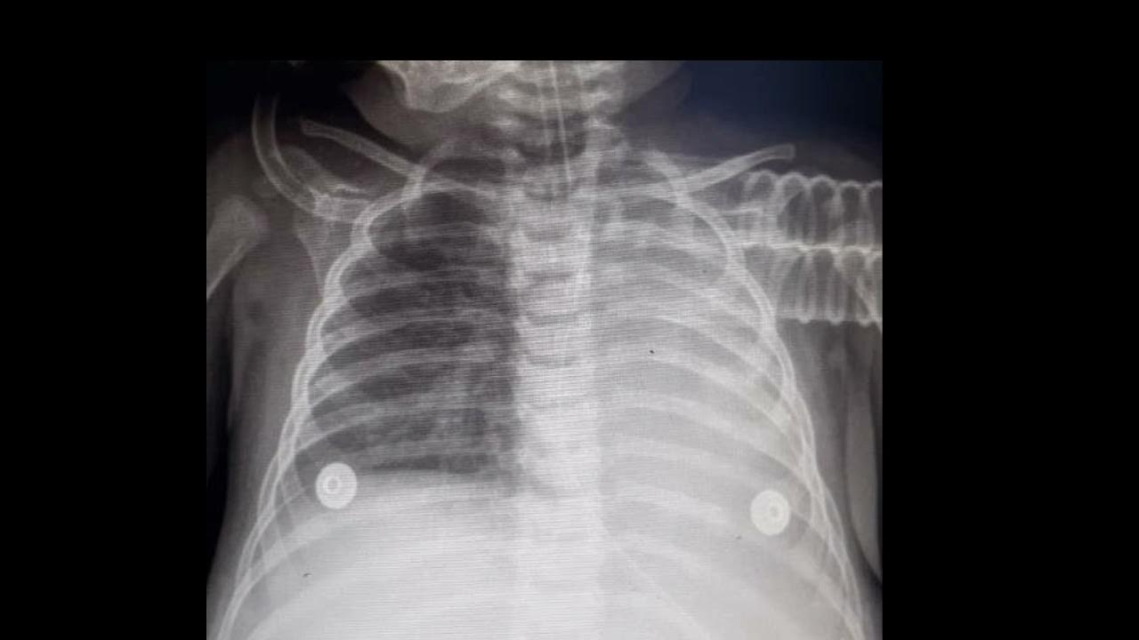 Common causes of unilateral white out lung 🫁in CXR ,pneumonia, pleural