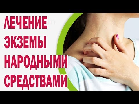 Лечение экземы народными средствами в домашних условиях