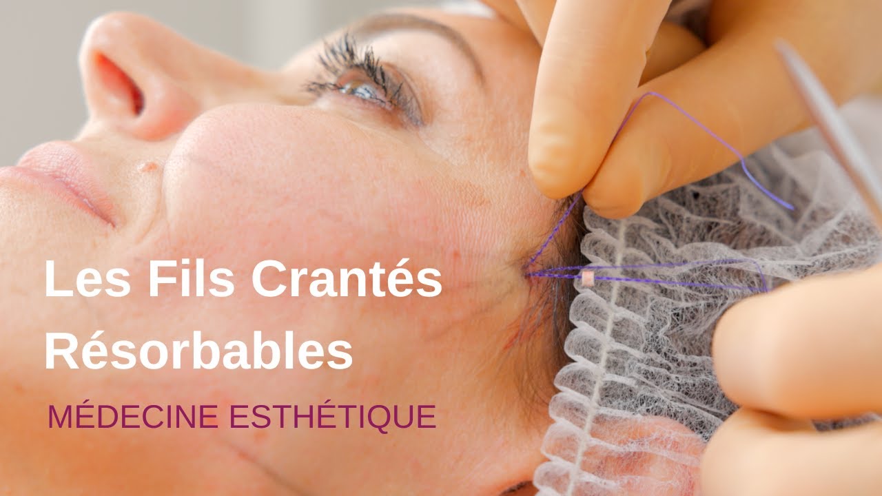 La pose de  Fils Tenseurs ou Fils Crantés Résorbables à Genève - Dr Levy, Médecin Esthétique Expert