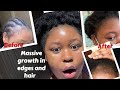 How to grow your edges faster| How to treat Aloepecia quickly| Hair loss

#Edgeentity #naturalhair