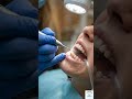 “Dark Stains Gone in One Visit!” #dental #dentalcare #toothpainrelief#dental tips#oralhygiene #teeth