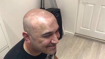 Client Reaction to his Scalp Micropigmentation treatment www.smphairclinic.co.uk