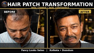 Hair Patch Transformation - Bald to Full Hair in Minutes Fancy Looks Salon Dum Dum