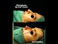 best rhinoplasty pakistan #asianrhinoplasty #bestresult #plasticsurgeon #liposuction #nosereshaping