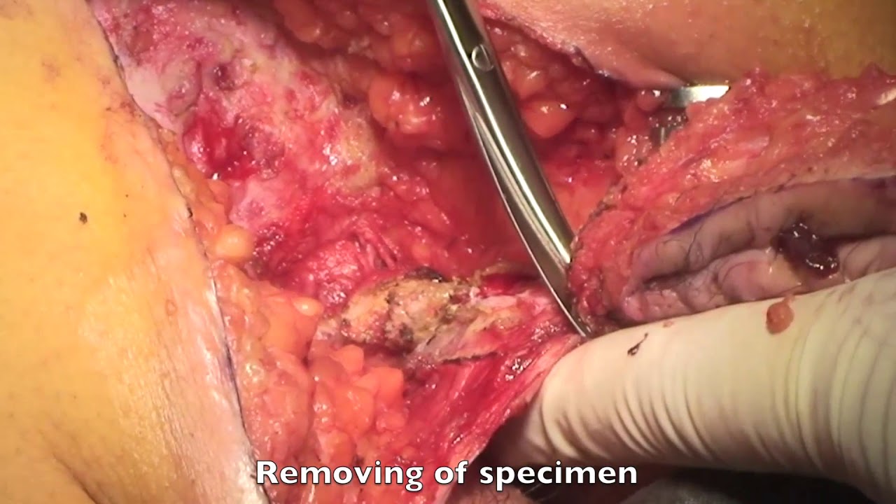 Excision of Extensive Recurrent Pilonidal Cyst with Gluteus Muscle Fascia  Plasty & Mid-line Closure - YouTube