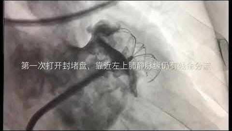 Large LAA implant by Lifetech LAmbre device