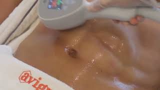 Get Rid Of Stomach Rolls Avignon Exilis Elite