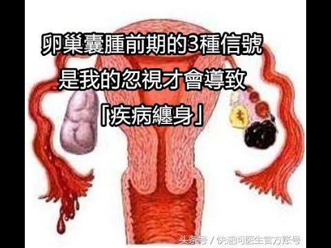 卵巢囊腫前期的3種信號，是我的忽視才會導致「疾病纏身」