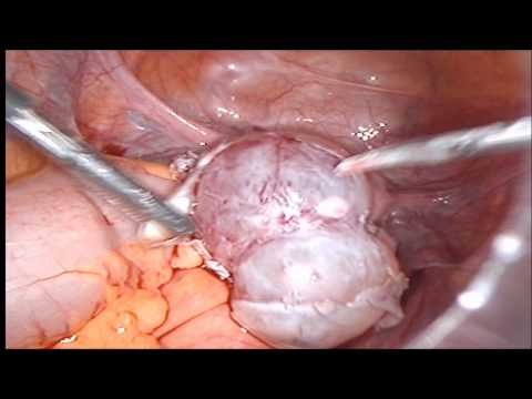 Video: Endometrioidna Cista - Liječenje, Operacija, Uklanjanje