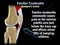 Patellar Tendonitis Jumper's Knee - Everything You Need To Know - Dr. Nabil Ebraheim