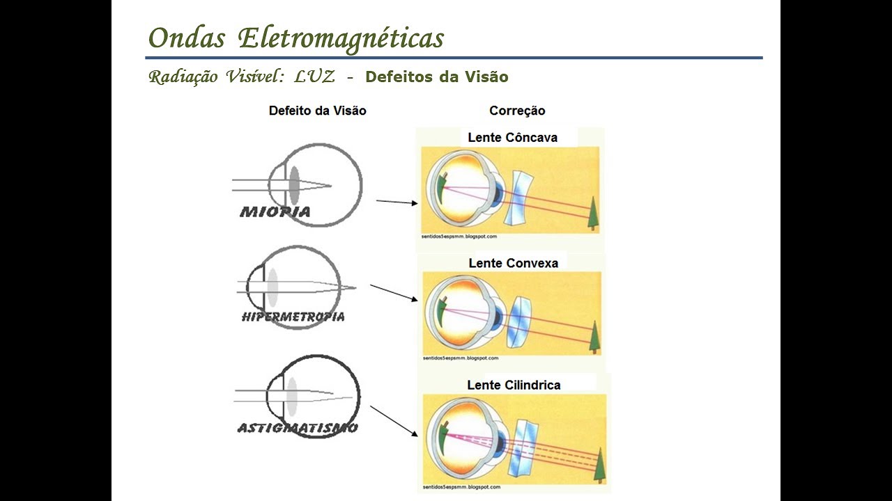 miopia hipermetropia astigmatismo presbiopia e estrabismo