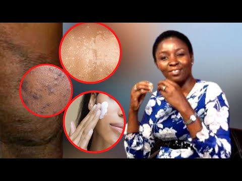 Video: Daktari Wa Ngozi Alionya Dhidi Ya Kutumia Vinyago Vya Uso Vilivyotengenezwa Nyumbani