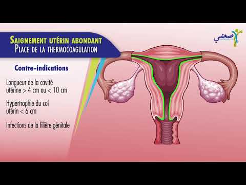 Vidéo: Traitement De L'hyperplasie De L'endomètre Avec Des Remèdes Et Des Méthodes Populaires