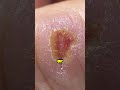The “Flesh-Eating” Warning You Need to Know