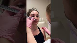 Details I'm done with lip fillers 🦆✂️ #LipLiftTurkey #LipSurgery #PermanentLipFlip Guide