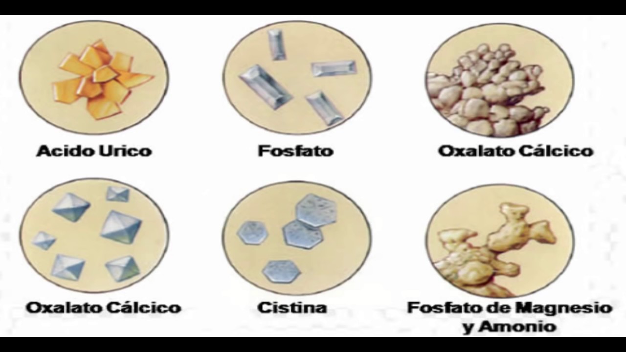 Por qué se forman piedras en el riñón - YouTube