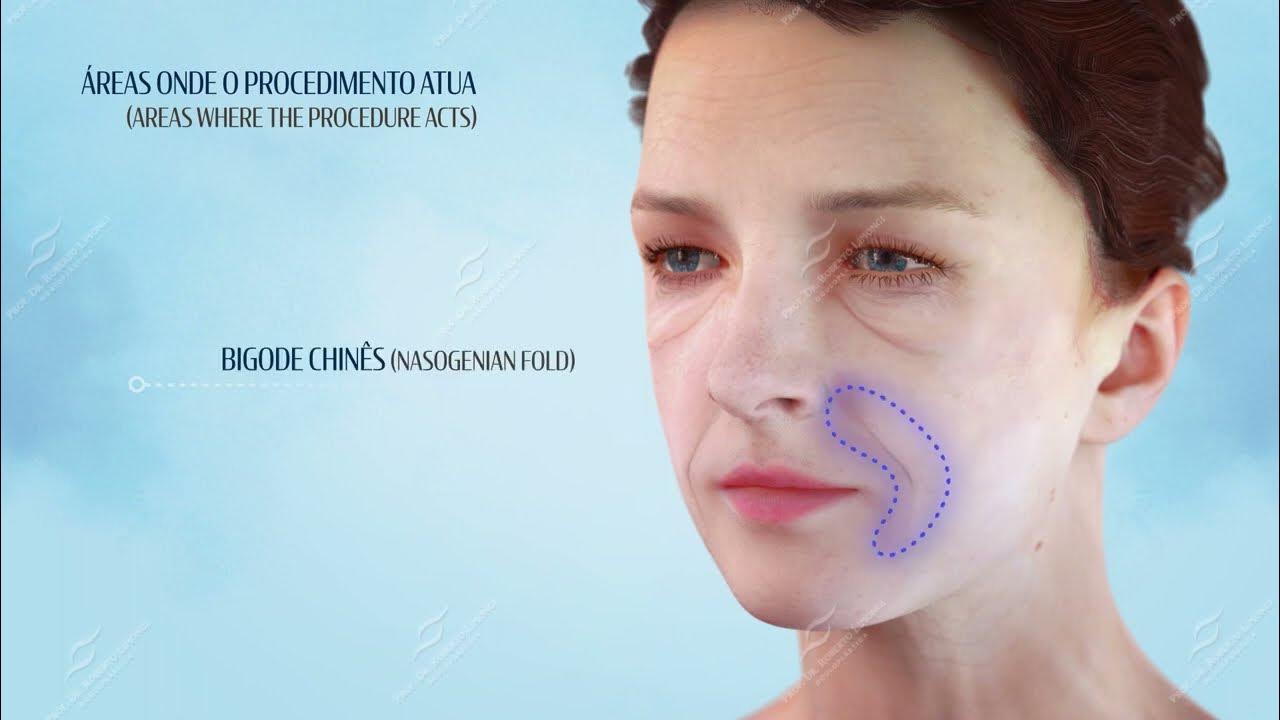 Blefaroplastia com a técnica SIM (Short Incision Midfacelift) Profº