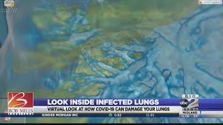 Inside look into how Covid-19 can damage your lungs
