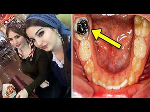 Twin Sister's Teeth Were Melting Away, 10 Years Later Dentists Make A Shocking Discovery