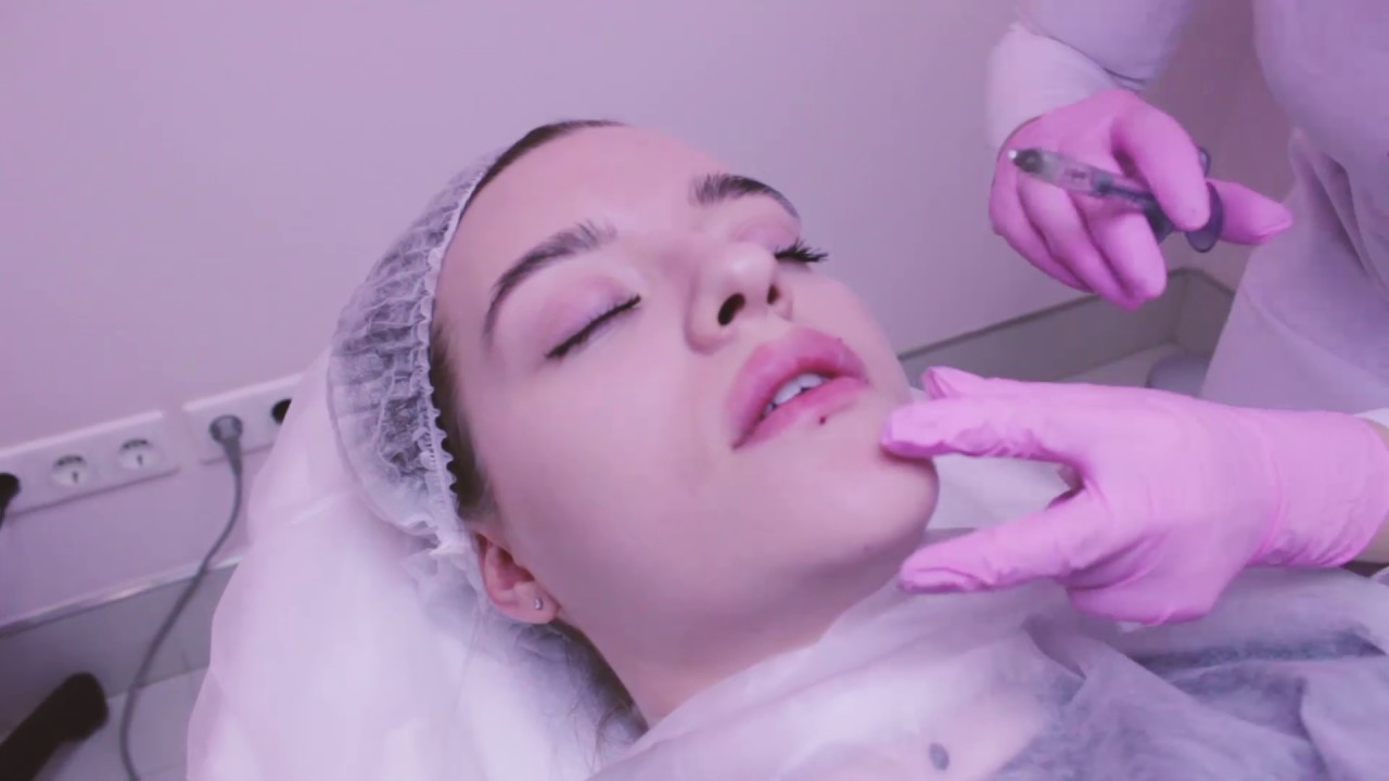 Увеличение губ препаратом ЮВИДЕРМ УЛЬТРА 4 by Dr.Lebedeva