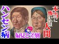 差別と偏見の歴史【ハンセン病】人を狂わせ続けた悪魔的感染症との戦いが凄い！感染症シリーズ#7