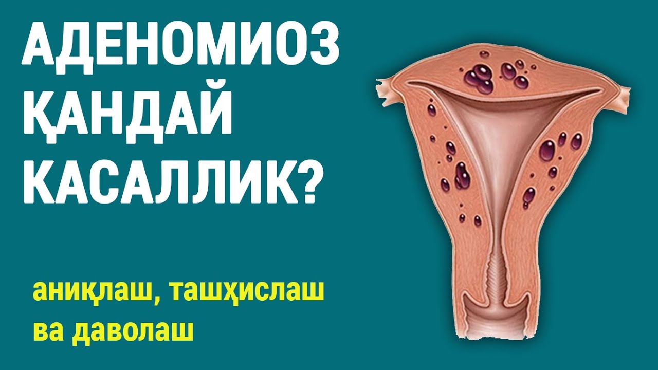 Аденомиоз қандай касаллик? Аниқлаш, ташҳислаш ва даволаш.