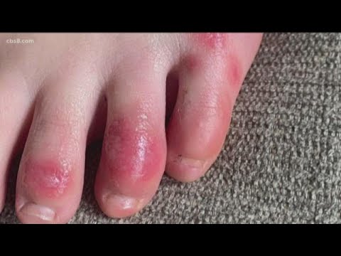 Video: Degetele de la picioare covid mâncărime?
