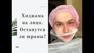 Видео Хиджама на лицо - подтяжка кожи, уменьшение морщин, уменьшение пигментации и пор (автор: Yuliya Khasanova)