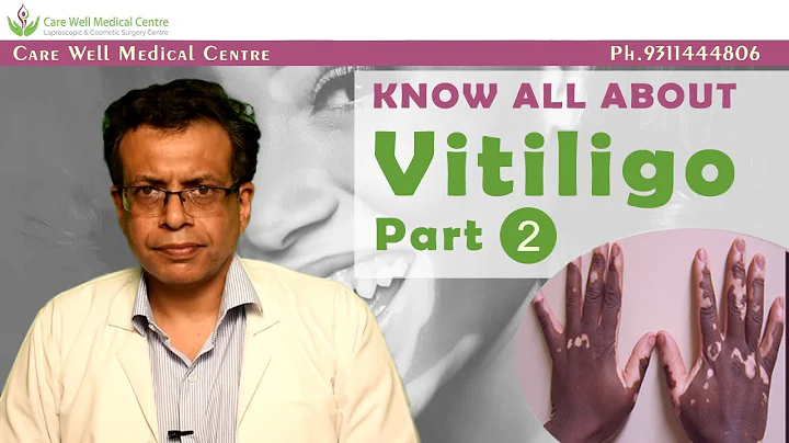 What is Vitiligo and Causes Of  Leucoderma  | Dr.S...