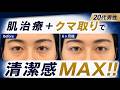 【24歳男性 クマ取り】肌が綺麗になったからこそ目立つクマ👁️目元が変われば印象が改善✨【脱脂+ヒアルロン酸】