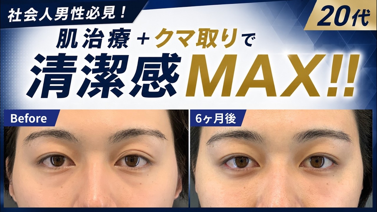 【24歳男性 クマ取り】肌が綺麗になったからこそ目立つクマ👁️目元が変われば印象が改善✨【脱脂+ヒアルロン酸】