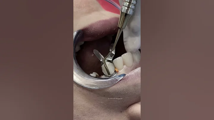 Composite veneer for anterior teeth #dentist